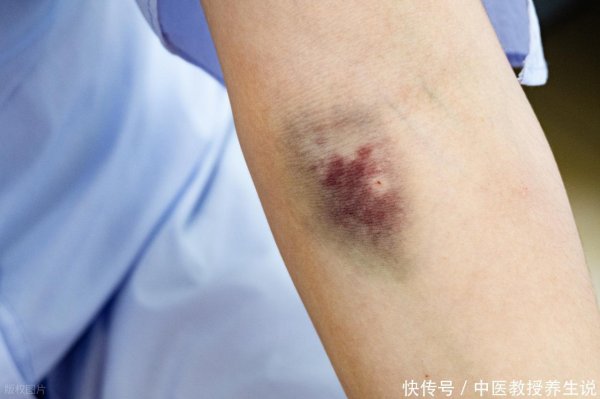 达道宝 女人膝盖淤青到底是怎么回事？医生：查清3个问题，必要时就诊